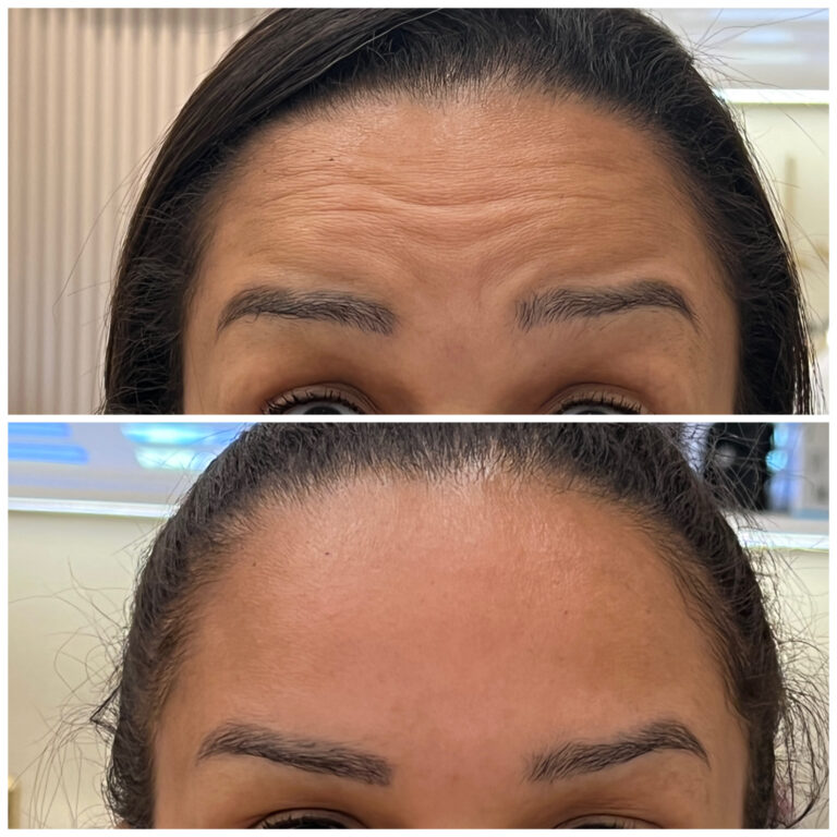 Botox-02-Copia-scaled.jpg