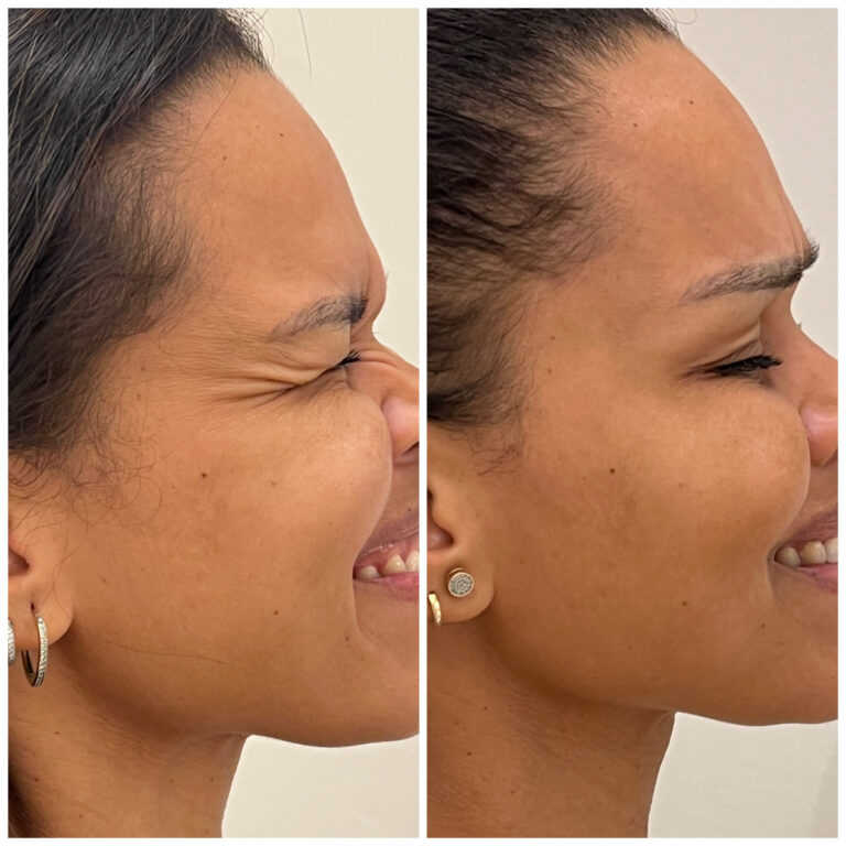 Botox-Copia-scaled.jpg