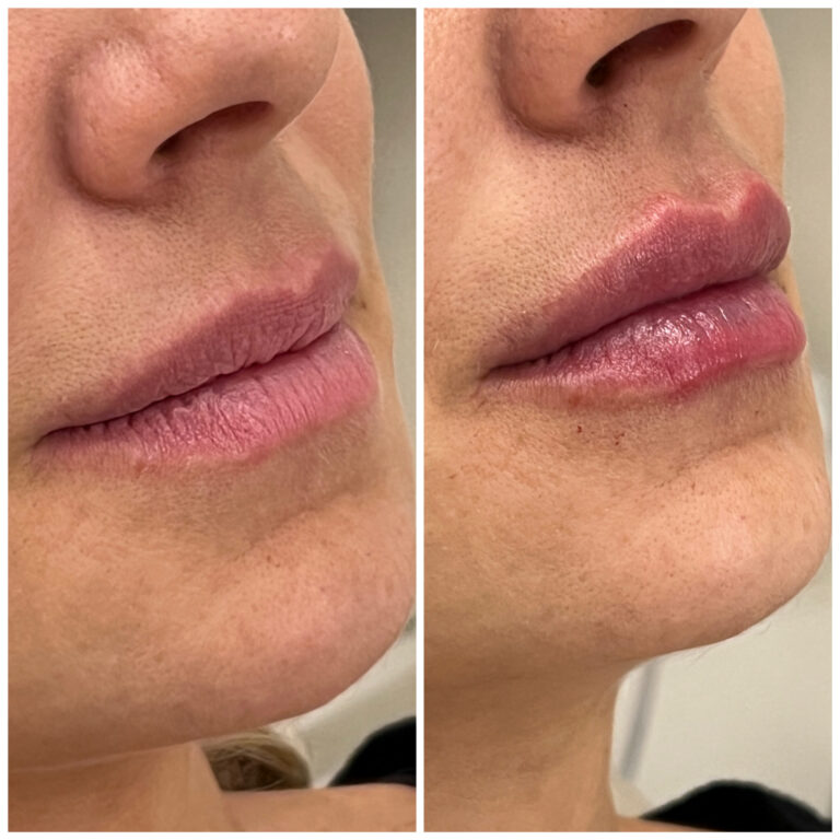 Preenchimento-labial-Copia-scaled.jpg