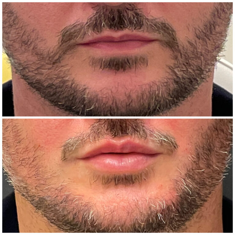 Preenchimento-labial-masculino-Copia-scaled.jpg