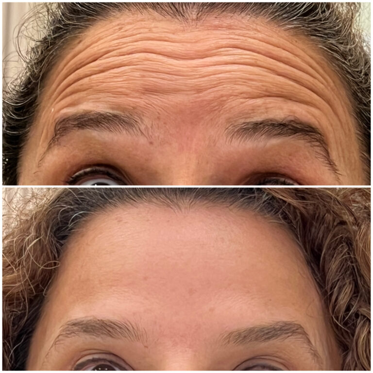 Botox